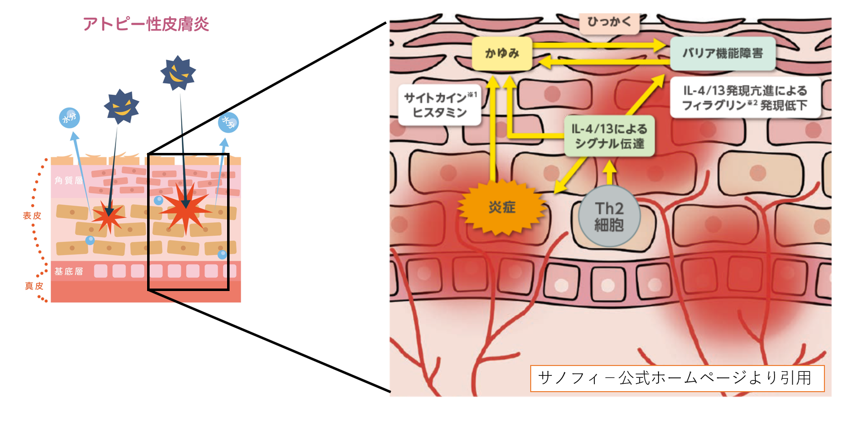 さまざまな種類の皮膚炎とそれらが皮膚にどのように現れるか