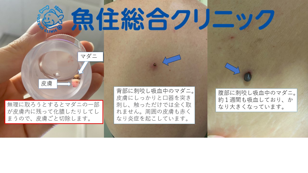 マダニに注意！！マダニに刺されたらどうしたらいいの？ | 門前仲町駅徒歩4分、江東区永代の魚住総合クリニック｜整形外科・リハビリ科・内科・皮膚科